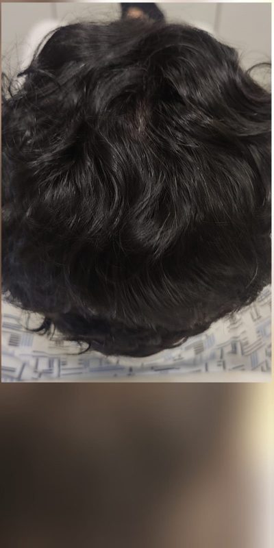 After treatment