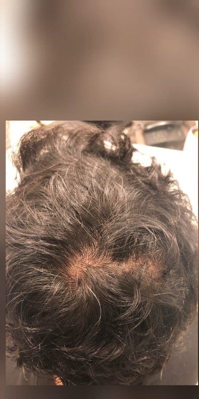 Before treatment