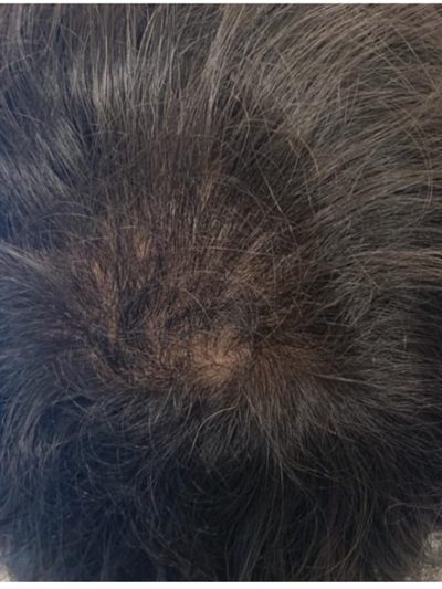 After treatment