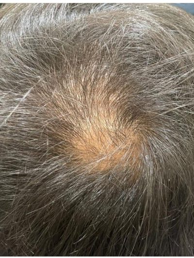 Before treatment