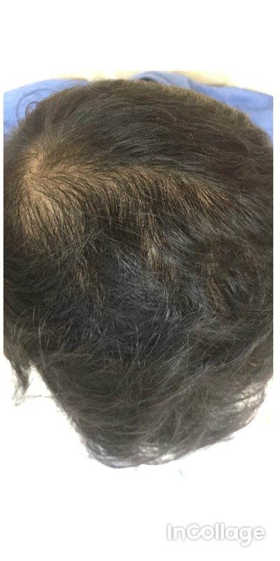After treatment